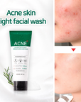 Acne AHA BHA PHA 30 Days Miracle Acne Clear Foam - BASIC MADE CO