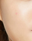 Acne Pimple Master Patch - BASIC MADE CO